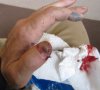 Clark's thumb at urgent care Issaquah 5-25-2011.jpg