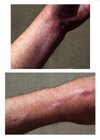 LeftArmSurgery.jpg