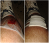LEG WOUND.png