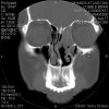 Cobble Sinus X ray 20014.jpg