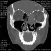 Cobble Sinus X ray 20017.jpg